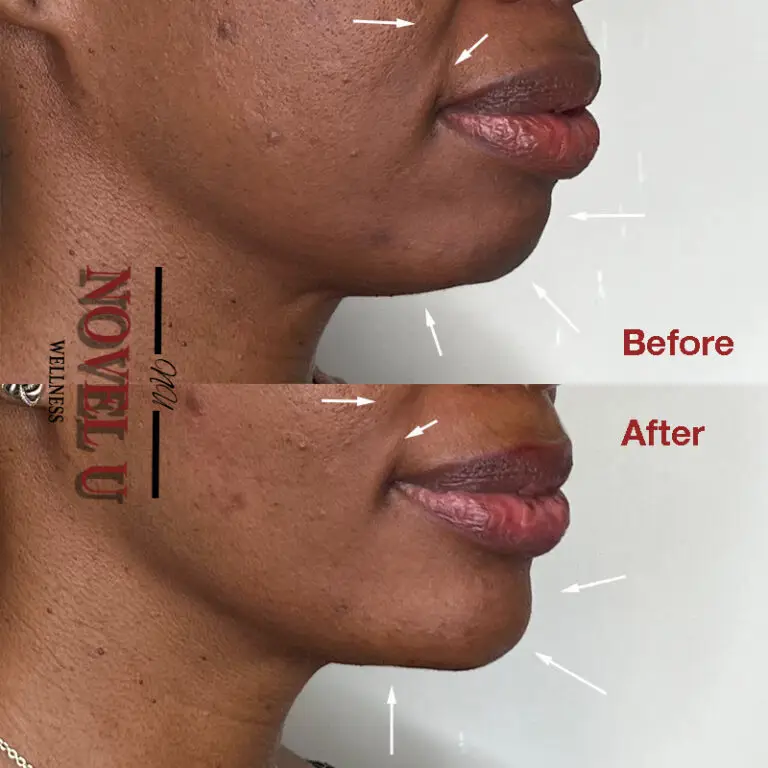 Before & After