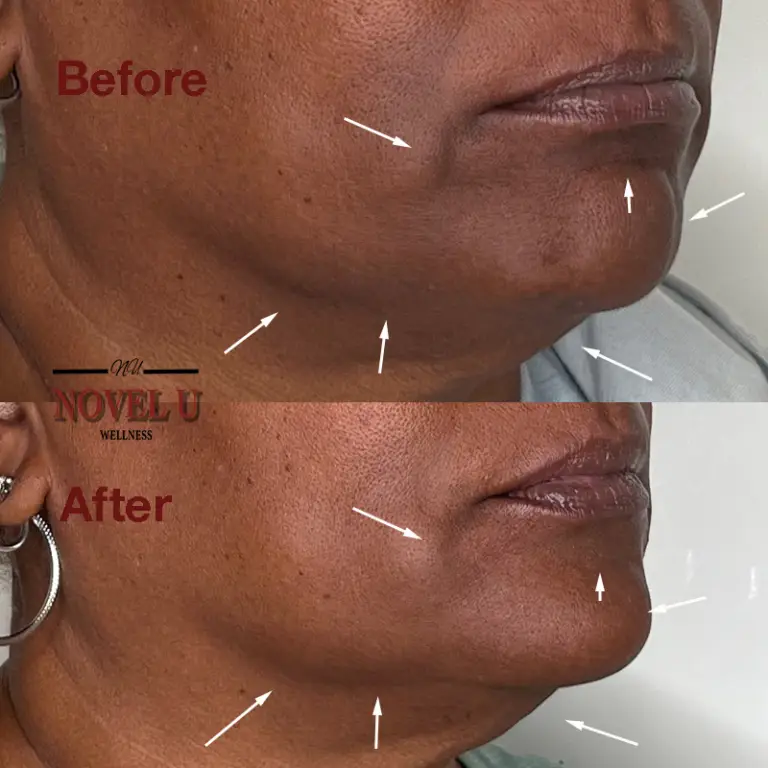 Before & After