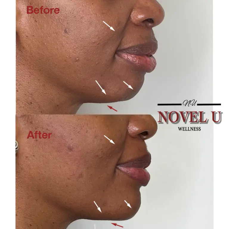 Before & After