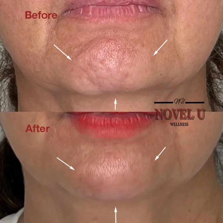 Before & After
