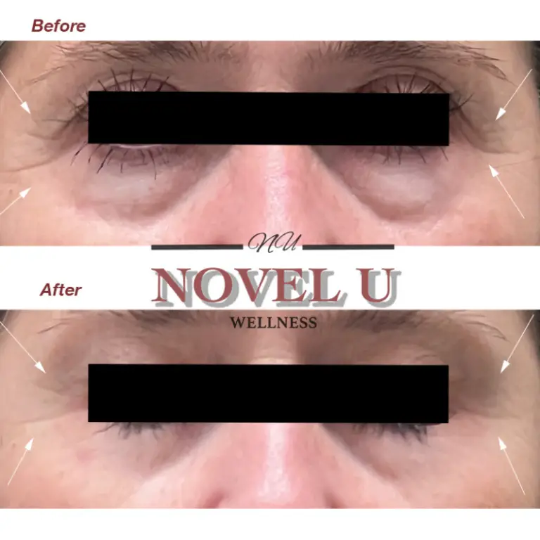 Before & After