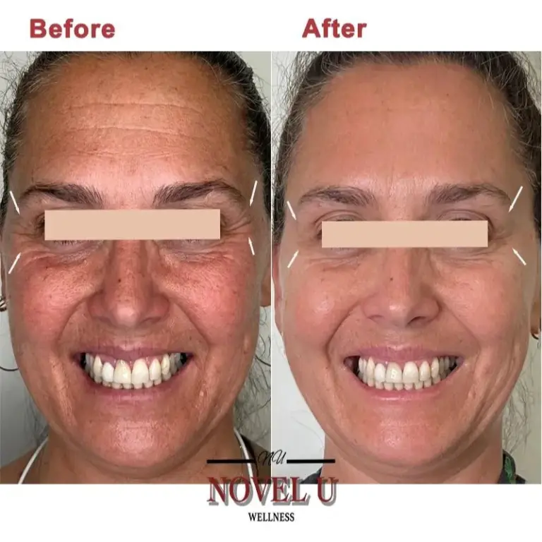 Before & After