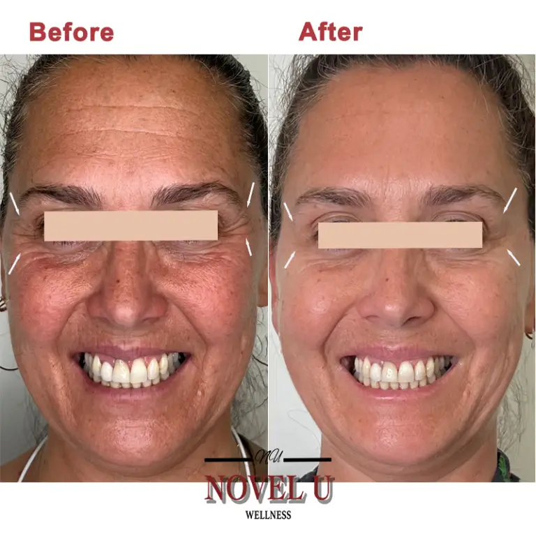 Before & After