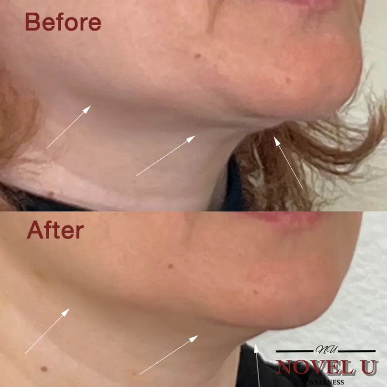 Before & After