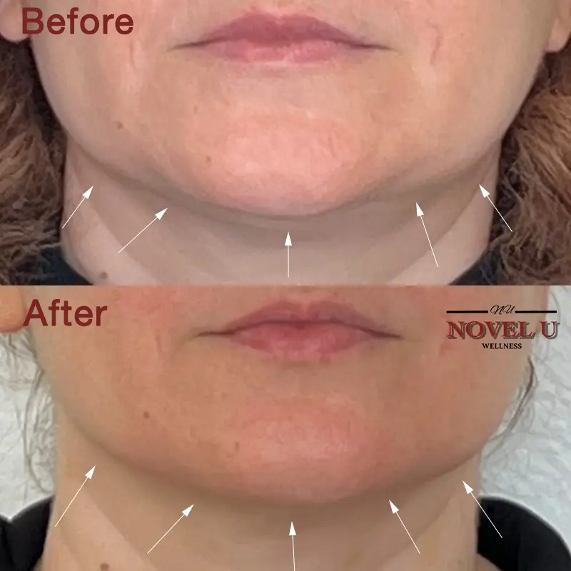 Before & After