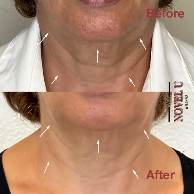 Before & After