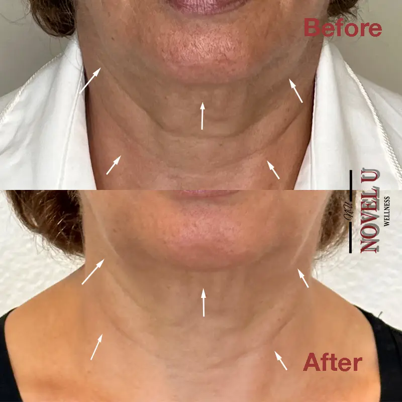 Before & After