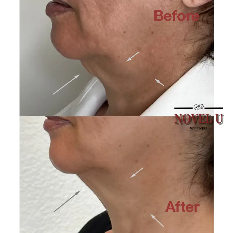 Before & After