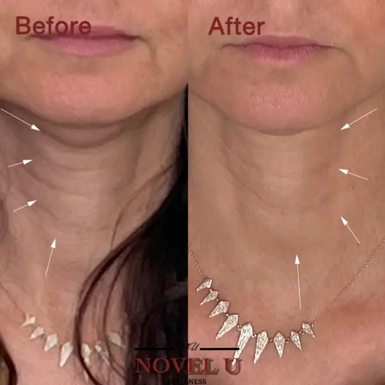 Before & After