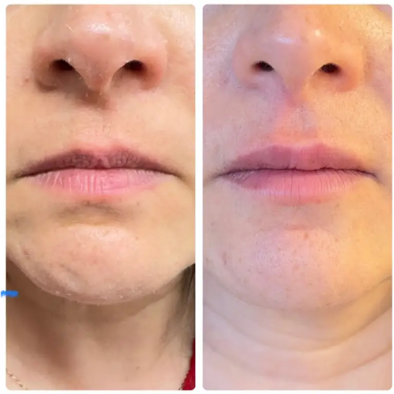 Before & After