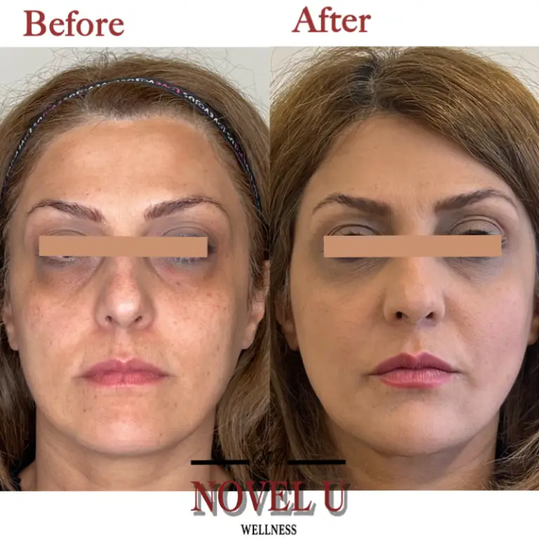 Before & After
