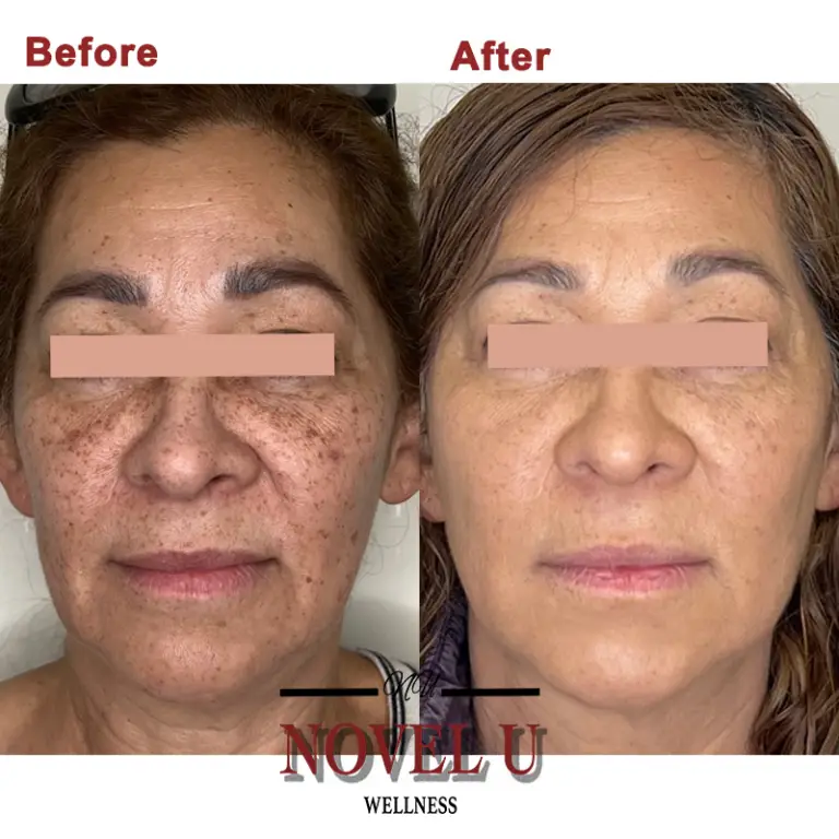 Before & After
