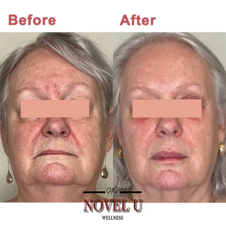 Before & After