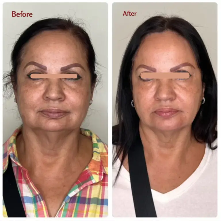 Before & After