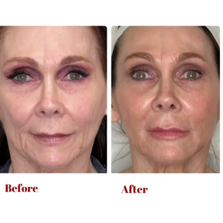 Before & After