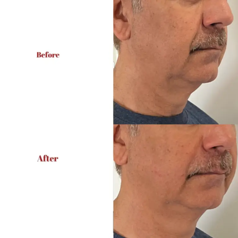 Before & After