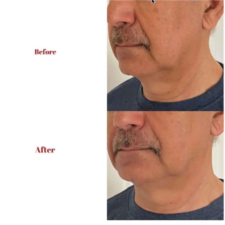 Before & After