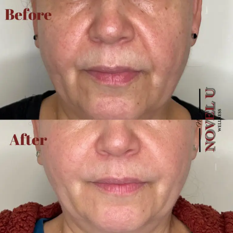 Before & After