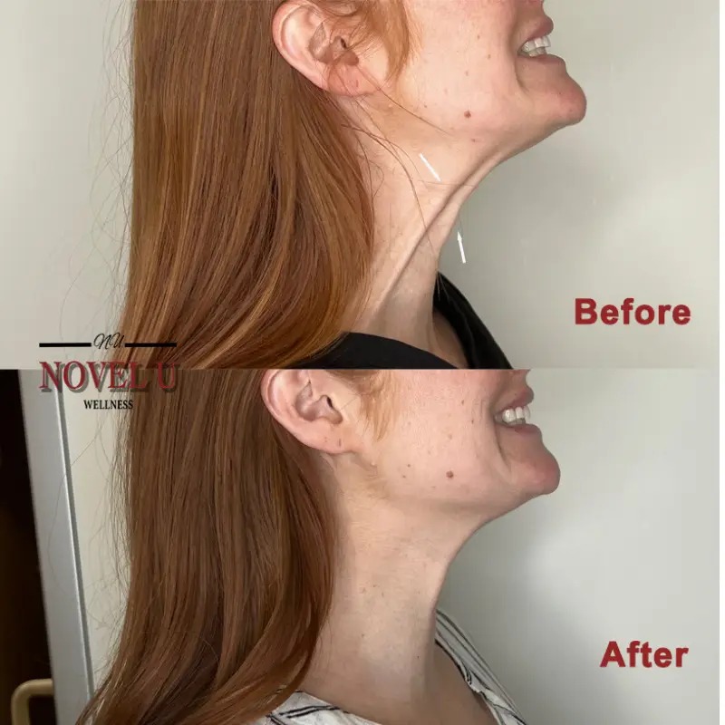 Before & After