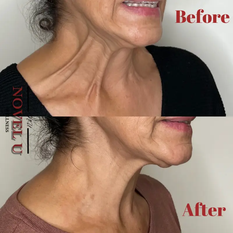Before & After