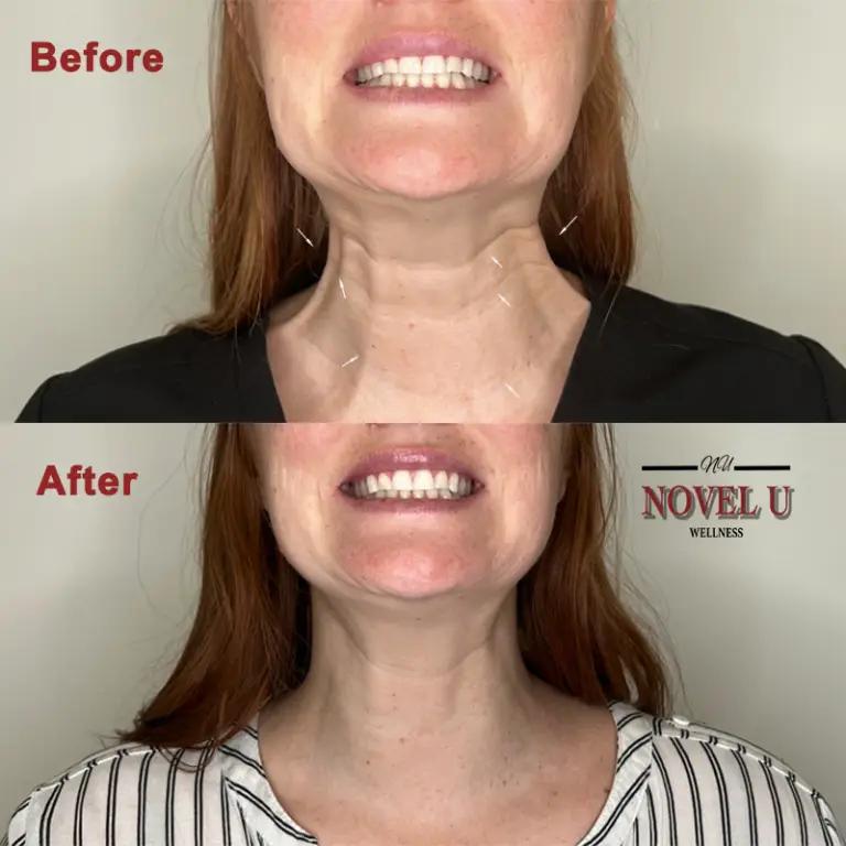 Before & After