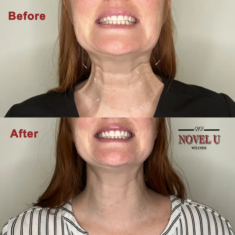 Before & After