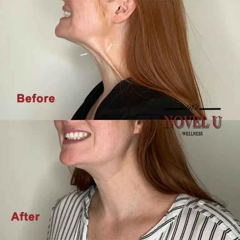 Before & After
