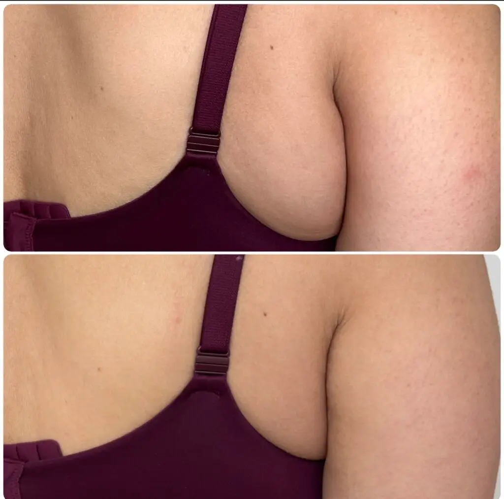 Bra Fat Removal Med Spa in long Beach