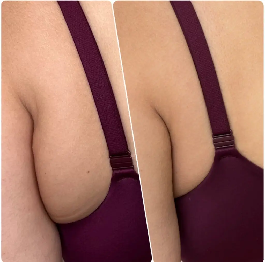 Bra Fat Removal Med Spa in long Beach