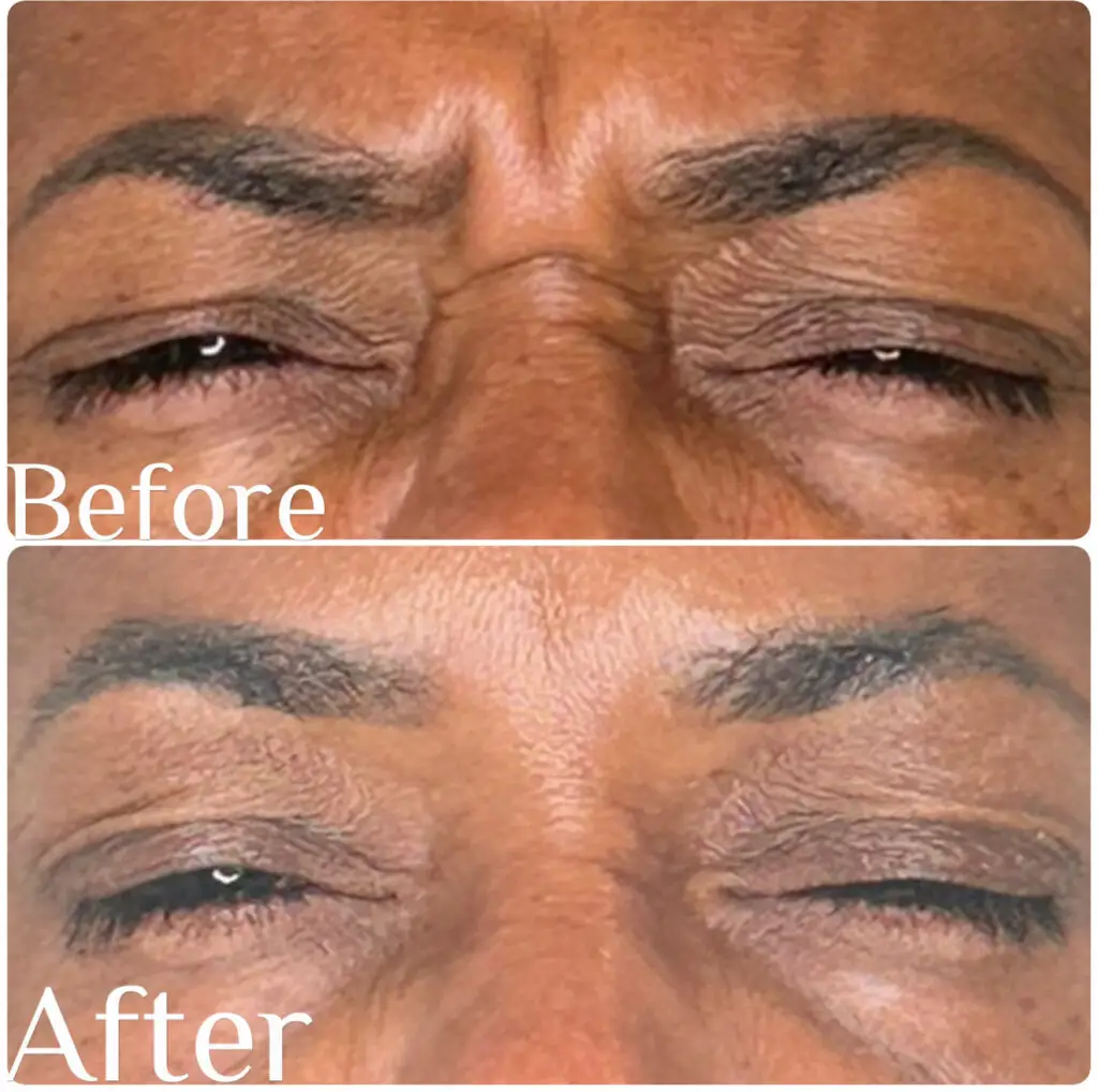  Botox cosmetic treatment
