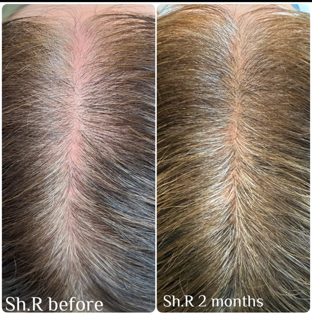 Before & aftetr