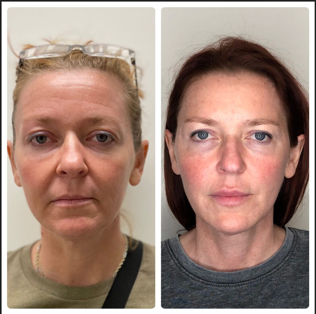 Before & aftetr
