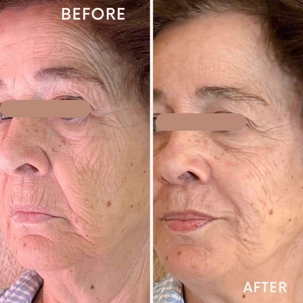 Befor & After