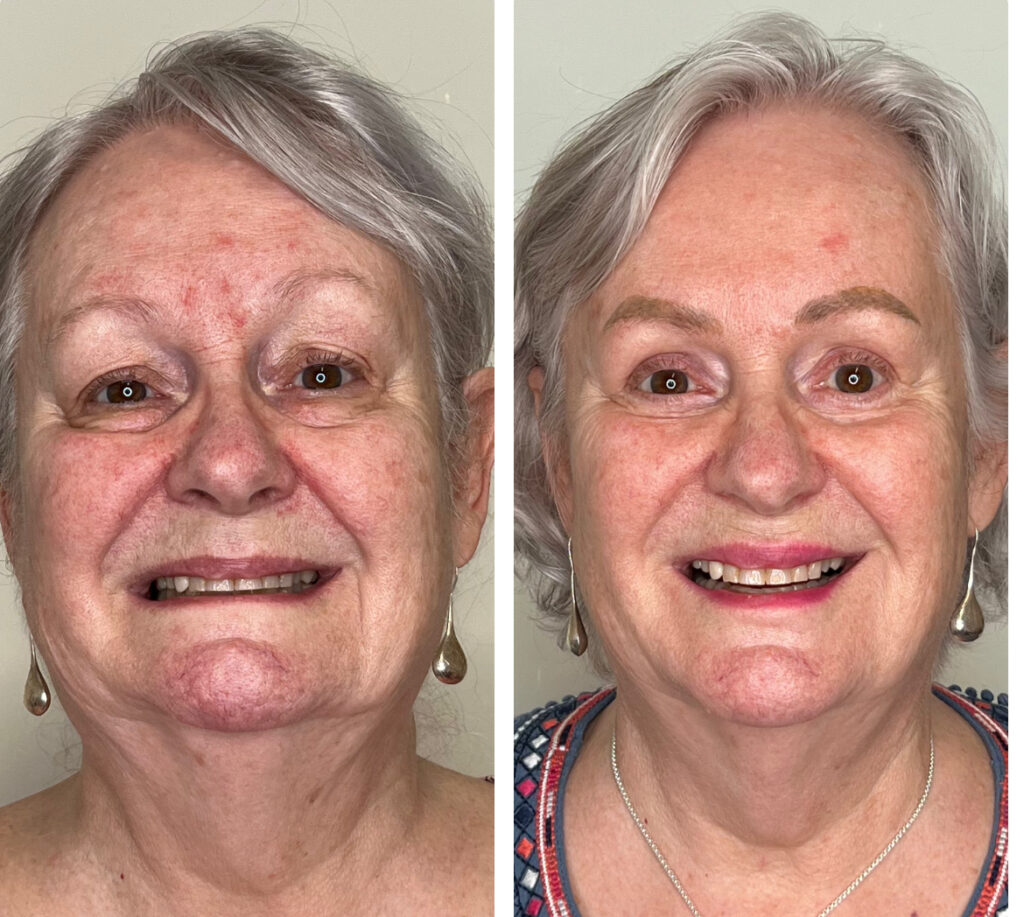 Before & aftetr