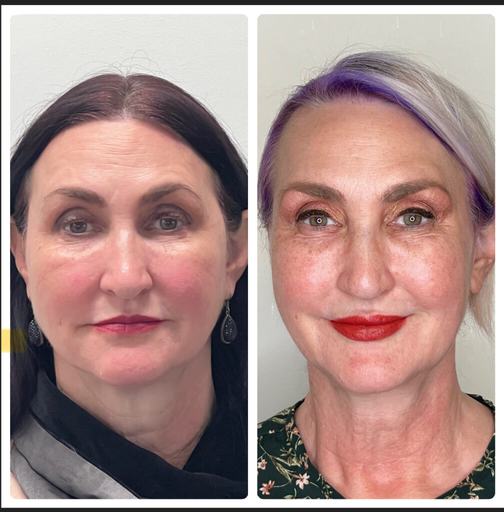 Before & After