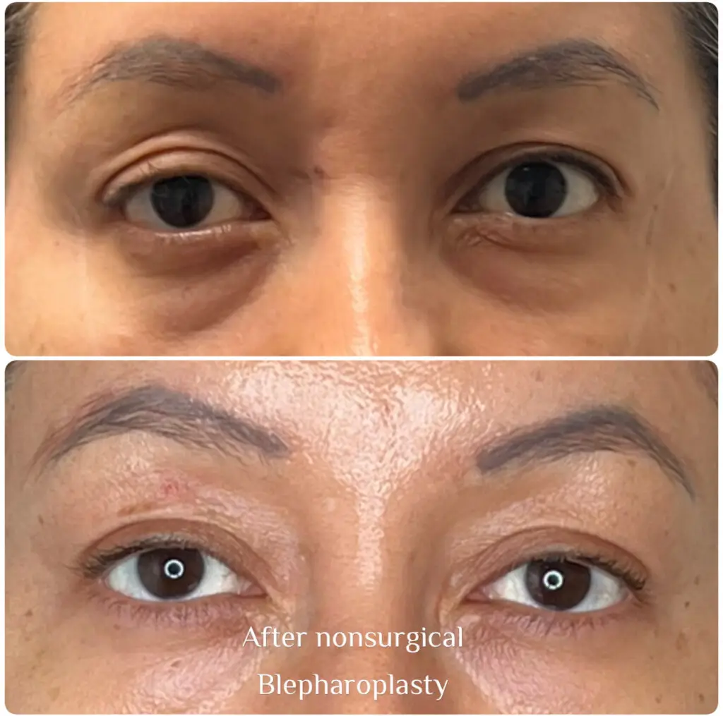 recommend a non-invasive machine for eyelid wrinkles after semaglutide. Agnes RF Radiofrequency With GLP-1 medications like Ozempic