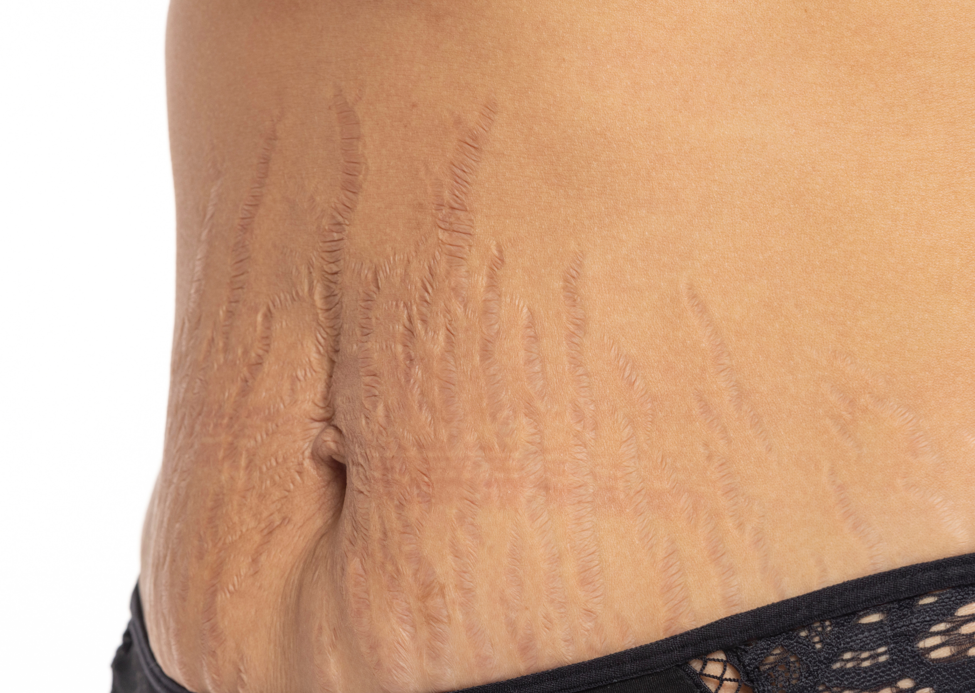 Stretch Mark Treatments: Dr. Shahnoos Provides Expert Advice