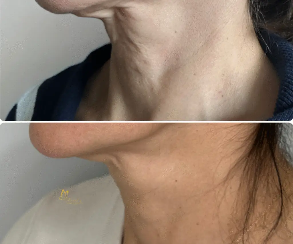 Sculptra med spa in long Beach