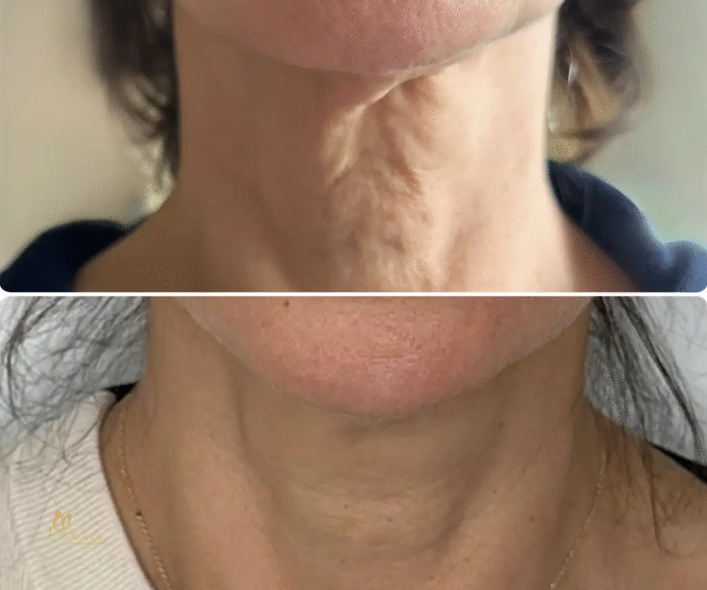 Sculptra med spa in long Beach