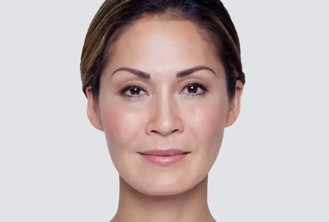 Restylane® Dermal Fillers in Long Beach, CA