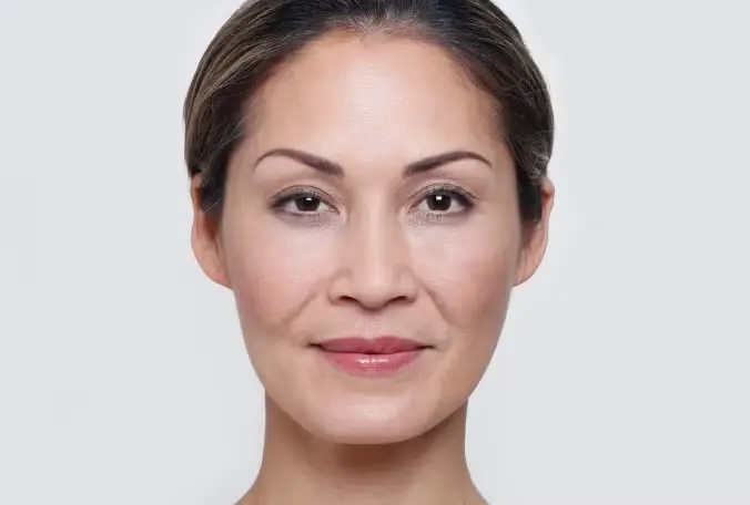Restylane® Dermal Fillers in Long Beach, CA