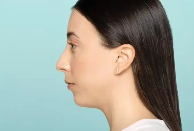 Restylane® Dermal Fillers in Long Beach, CA