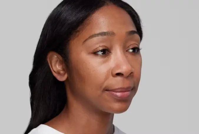 Restylane® Dermal Fillers in Long Beach, CA